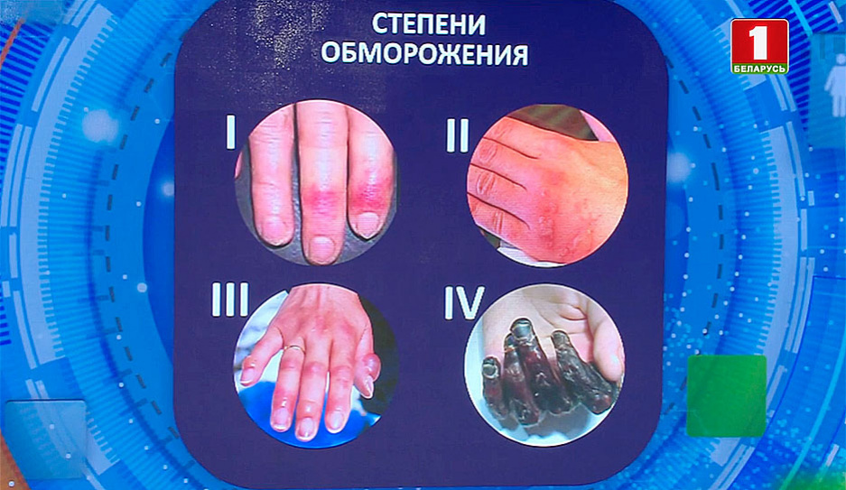 Обморожение пальцев рук и первая помощь пострадавшему